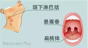 扁桃体总是发炎，要不要切掉？