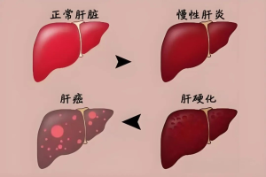 科学防治肝病，远离“肝”扰