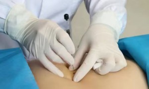 关于穴位埋线减肥，你想知道的那些事儿