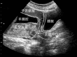 再谈前置胎盘