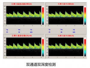 带你了解颅内多普勒检查