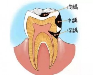在家隔离-如何有效预防龋齿？