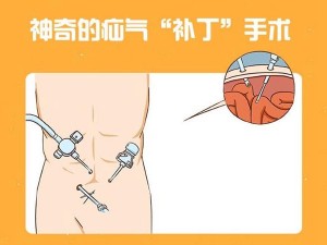 疝修补术的新招 --腹腔镜下疝修补术
