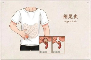 善变的“阑尾”