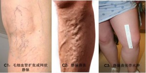 您的腿上有“蚯蚓纹身”么