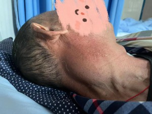 宁南县人民医院消化内科（肿瘤专业）：化疗联合免疫治疗淋巴瘤显奇效