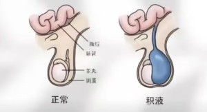 “蛋蛋”的烦恼——小儿鞘膜积液