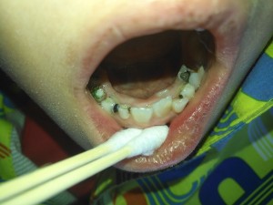 孩子的牙齿不整齐咋办